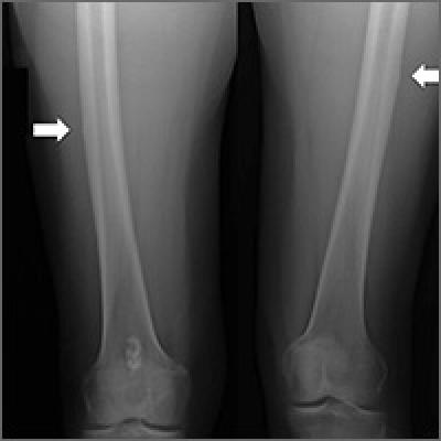 Bilateral thigh and knee pain • leg weakness • no history of trauma