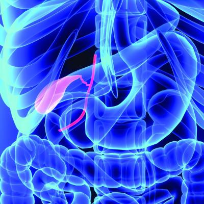 Bile spillage during lap cholecystectomy comes with a price | MDedge ...