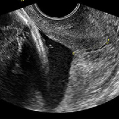 Universal cervical length screening–saving babies lives | MDedge ObGyn