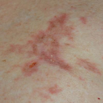 Squamoid Eccrine Ductal Carcinoma | MDedge Dermatology