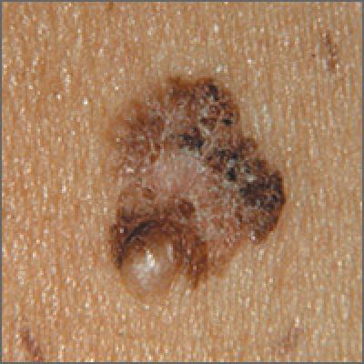 Changing mole on arm | MDedge Family Medicine