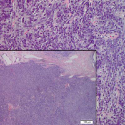 Solitary Tender Nodule on the Back | MDedge Dermatology