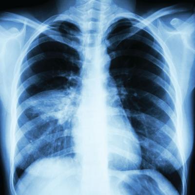 Guidelines updated for treating community-acquired pneumonia | CHEST ...