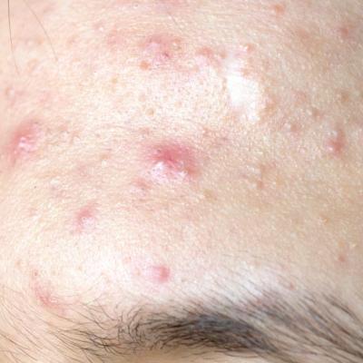 Topical treatment options for acne continue to expand | MDedge Dermatology