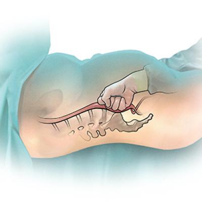 Postpartum hemorrhage: Aortic compression to reduce pelvic bleeding