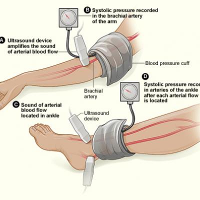 Six PAD diagnostic tests vary widely in patients with diabetes | MDedge ...