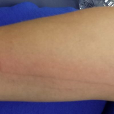 Clinical Challenge: White Scratch Marks on Leg - MPR