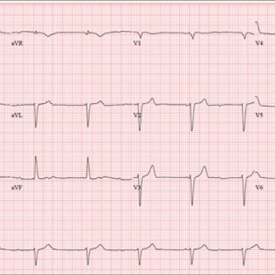 No Time for Chest Pain When There Are Chores to Do | Clinician Reviews