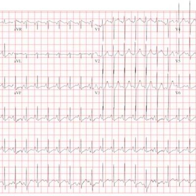 Worsening Symptoms in Woman with Cystic Fibrosis | Clinician Reviews