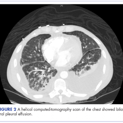 Bilateral chylothorax in an AIDS patient with newly diagnosed Kaposi ...