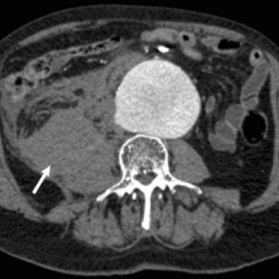 No Survival Benefit Seen For Evar Over Open Surgery For Ruptured Aaa 