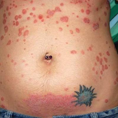 how long does psoriasis flare up last