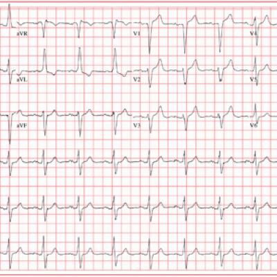 Woman with Chest Pain While in Mexico | Clinician Reviews