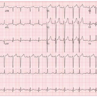 Should This Fitness Instructor Worry About Her Heart? | Clinician Reviews