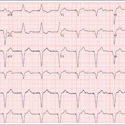 The Flu, or a Problem with His Pacemaker? | Clinician Reviews