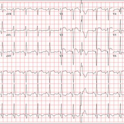 Chest Pain and Vomiting with Prior Heart Attack | Clinician Reviews