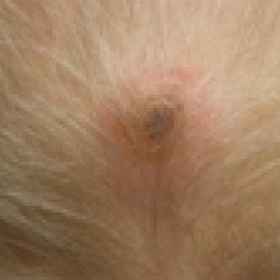 Lung Cancer–Associated Scalp Hair Loss: A Rare Cause of Secondary