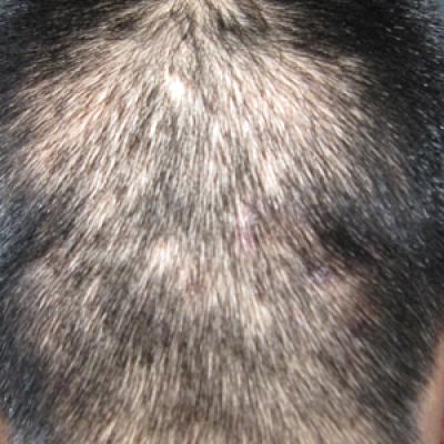 An Illustrative Case Report of Secondary Syphilis With Alopecia ...