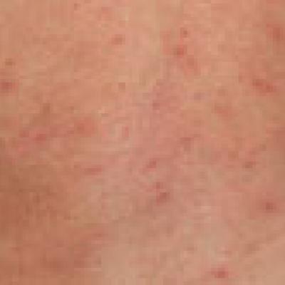 Post–Varicella-Zoster Virus Granulomatous Dermatitis: A Report of 2 ...