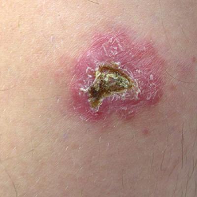 What Is Your Diagnosis? Old World Leishmaniasis | MDedge Dermatology