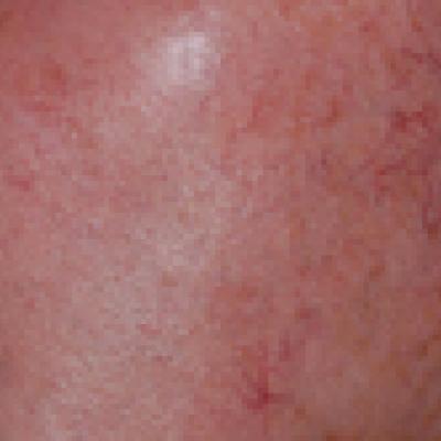 Consensus Recommendations From the American Acne & Rosacea Society on ...