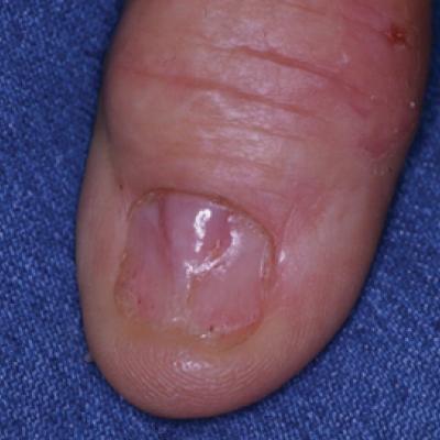 Tender Thumbnail Papule | MDedge Dermatology