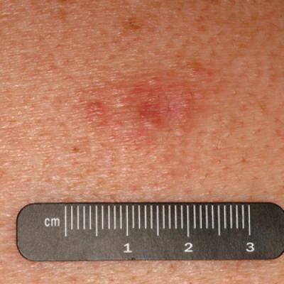 Primary Cutaneous Plasmacytoma | MDedge Dermatology