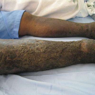 Unilateral Leg Swelling: Chronic Venous stasis vs Lymphedema