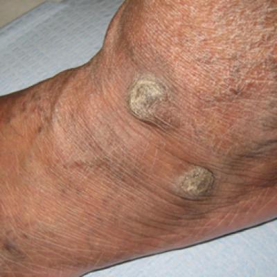 thick hard skin on side of foot