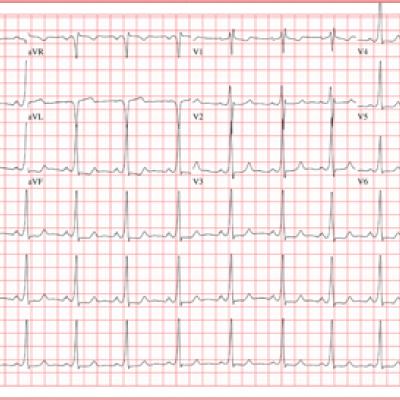 A History of Palpitations and Dizziness | Clinician Reviews