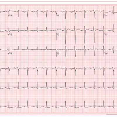 Atrial Flutter Follow-up | Clinician Reviews