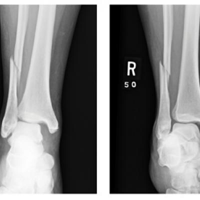 Woman with Severe Ankle Pain After Fall | Clinician Reviews