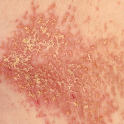 Man, 45, With Greasy Rash and Deformed Nails | Clinician Reviews