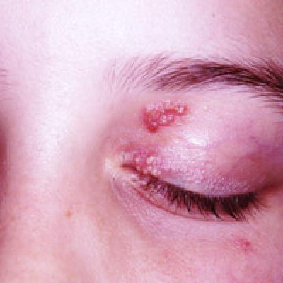 Recurrent Rash On Eyelid Cause For Concern Clinician Reviews