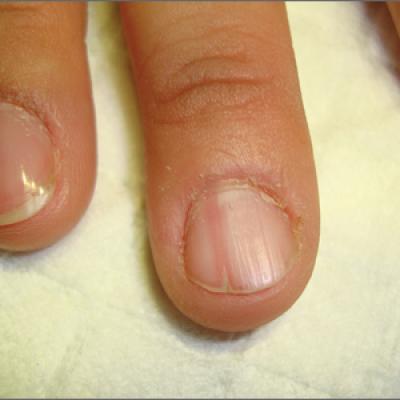 Reason For Skin Growth Under Nails  POPSUGAR Beauty