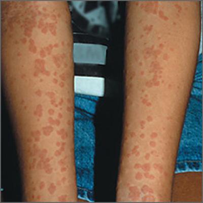 Nonpruritic Rash On Arms | MDedge Family Medicine