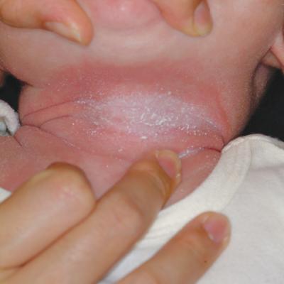 eczema on baby neck