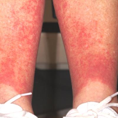 diabetes skin rash on legs