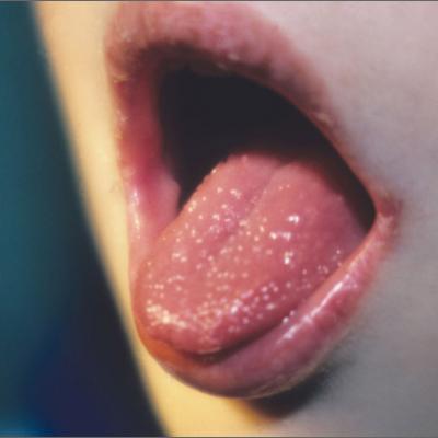 tongue papillae enlarged treatment