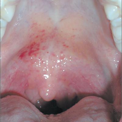 Throat Pain And Red Spots On Palate Mdedge Family Medicine