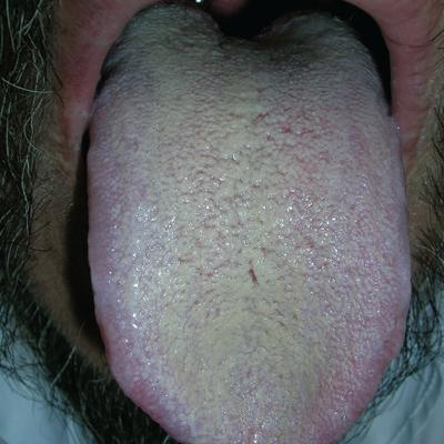 Discoloration of the tongue | MDedge Family Medicine