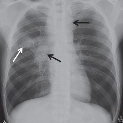 Persistent cough | MDedge Family Medicine