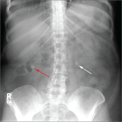 Bilateral Flank Pain in an Older Adult