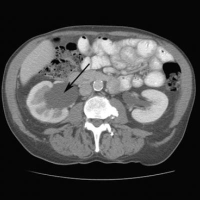 Flank pain  MDedge Family Medicine