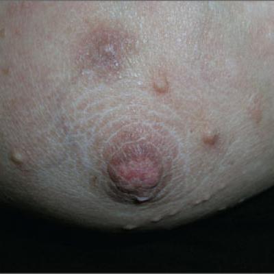 bumps on breast