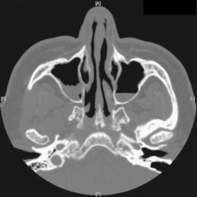 Sinus pressure | MDedge Family Medicine