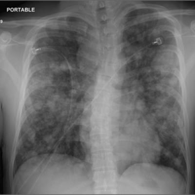 Teenager with shortness of breath and hypoxia | MDedge Family Medicine