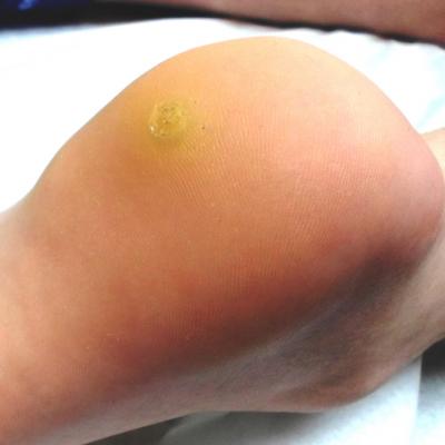 wart foot black dots