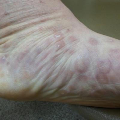 Syphilis Rash On Feet