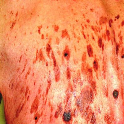 Small, Painful Blisters Erupt in Patient's Groin Area